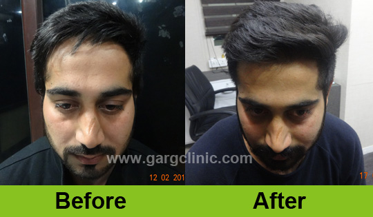 Garg Hair Transplant Clinic