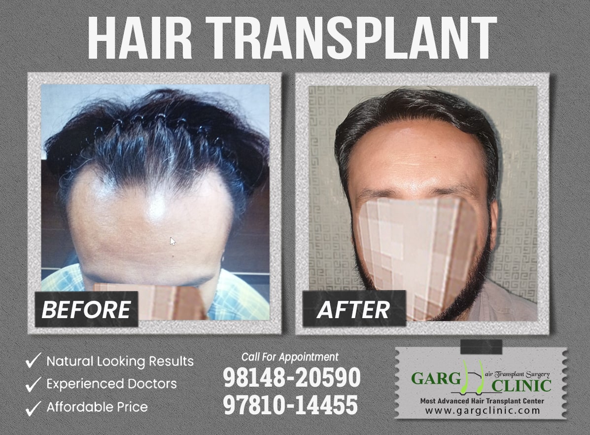 Garg Hair Transplant Clinic