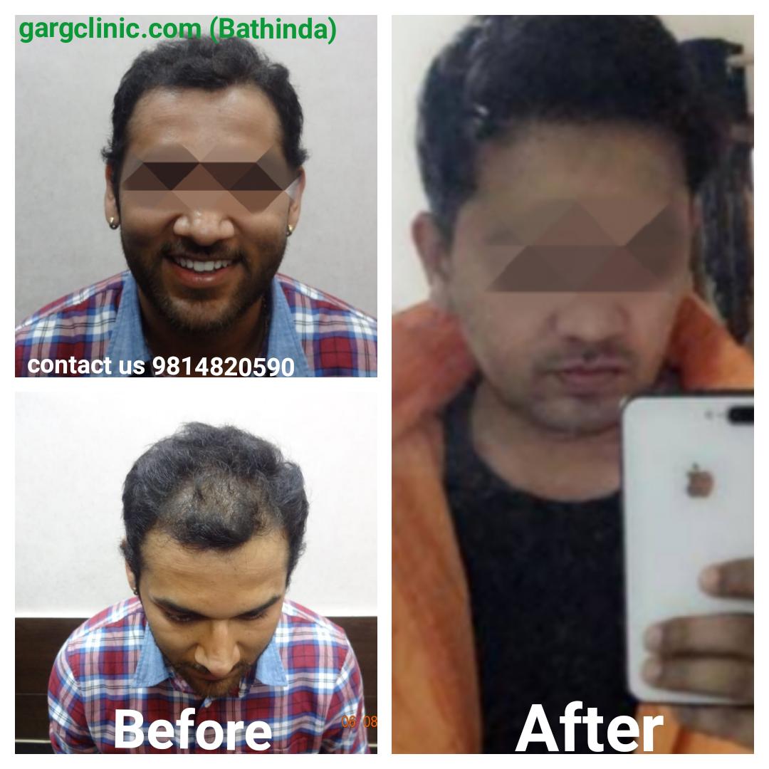 Garg Hair Transplant Clinic