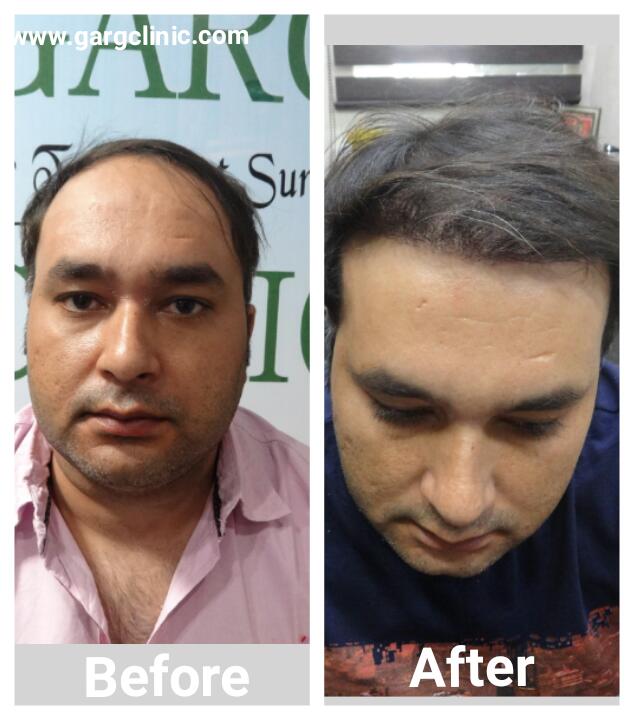 Garg Hair Transplant Clinic