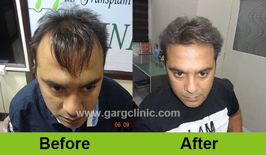 Garg Hair Transplant Clinic