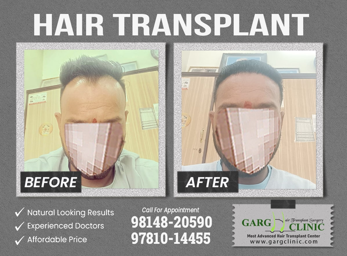 Garg Hair Transplant Clinic