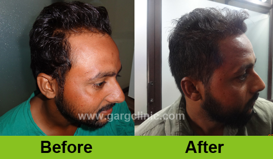 Garg Hair Transplant Clinic