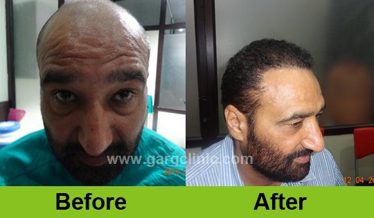 Garg Hair Transplant Clinic