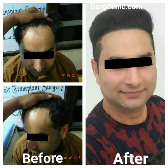 Garg Hair Transplant Clinic