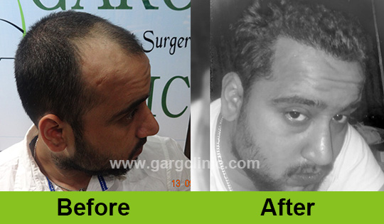 Garg Hair Transplant Clinic
