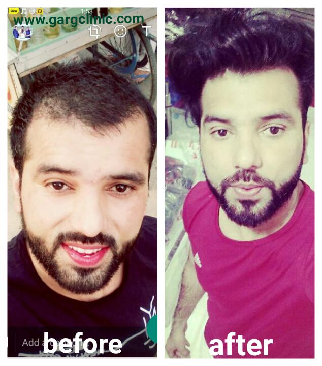 Garg Hair Transplant Clinic