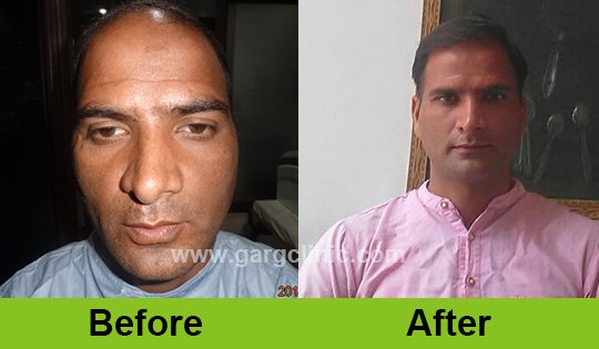 Garg Hair Transplant Clinic