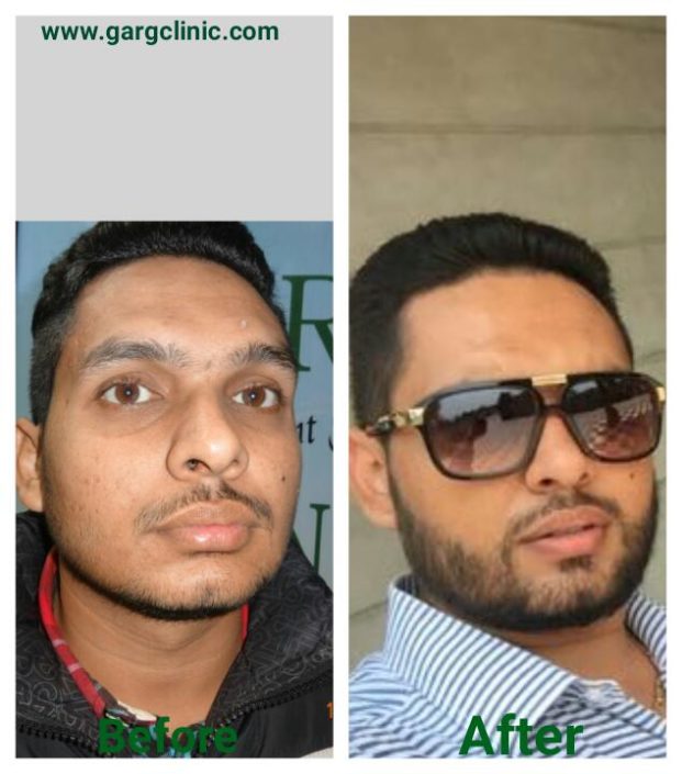Garg Hair Transplant Clinic