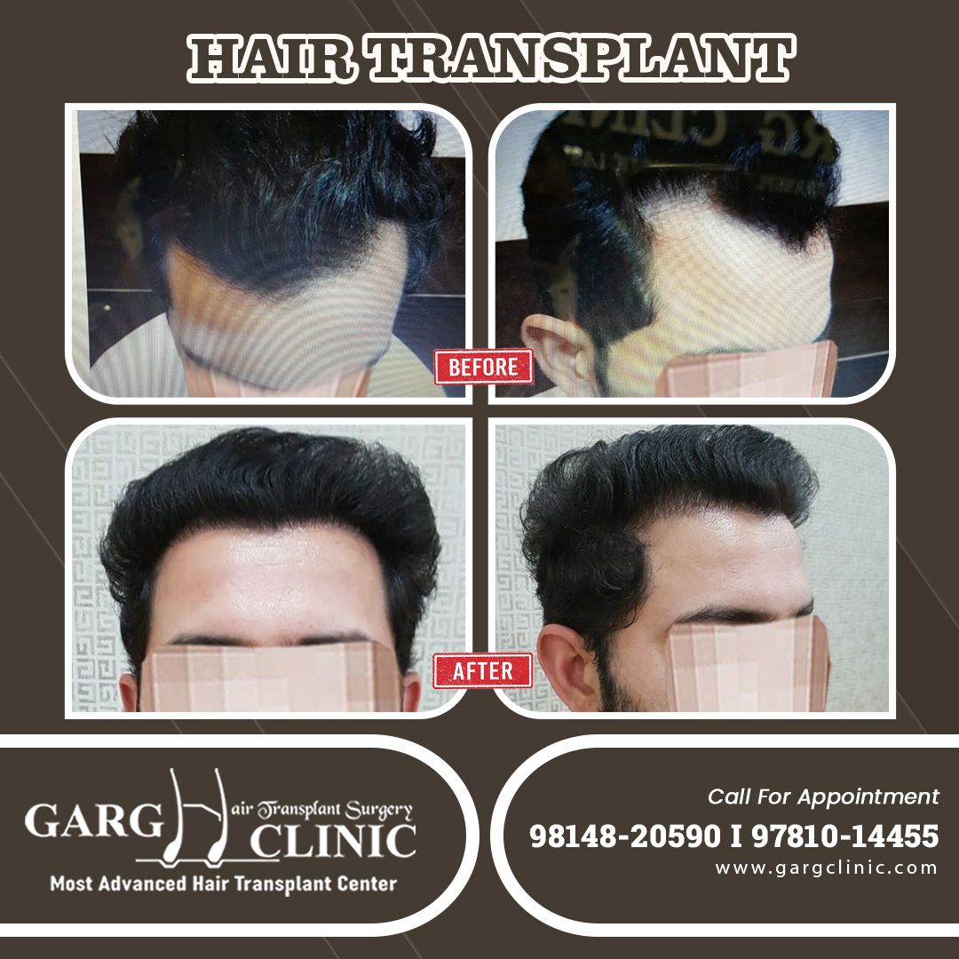 Garg Hair Transplant Clinic