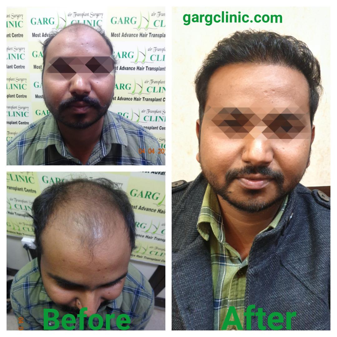 Garg Hair Transplant Clinic