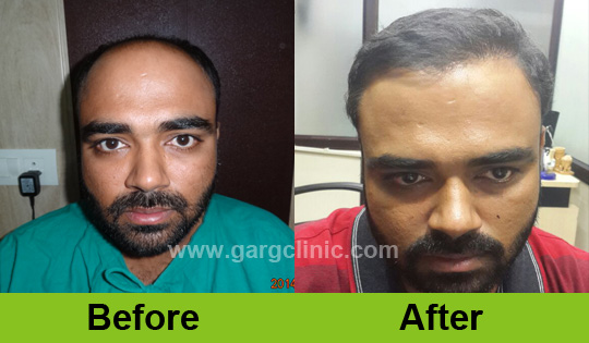 Garg Hair Transplant Clinic