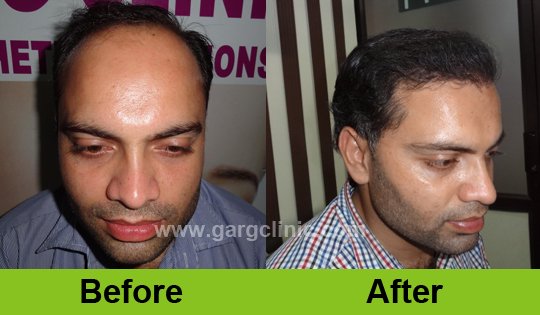 Garg Hair Transplant Clinic