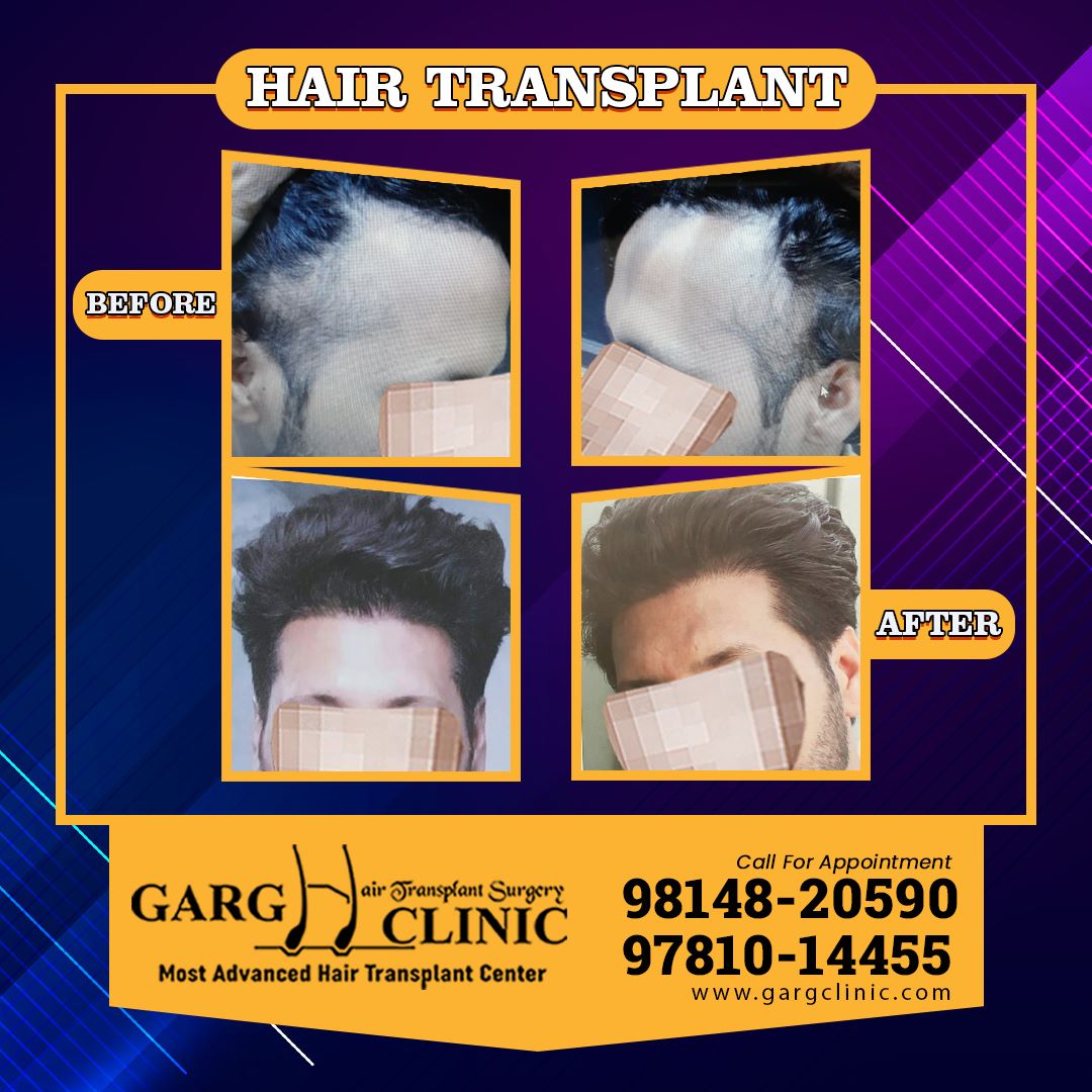 Garg Hair Transplant Clinic