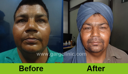 Garg Hair Transplant Clinic