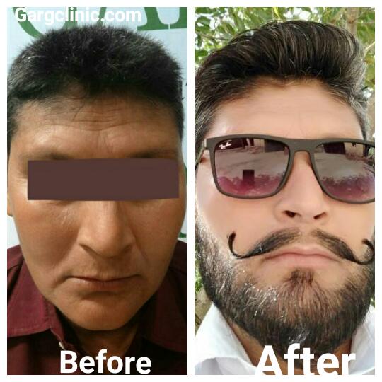 Garg Hair Transplant Clinic