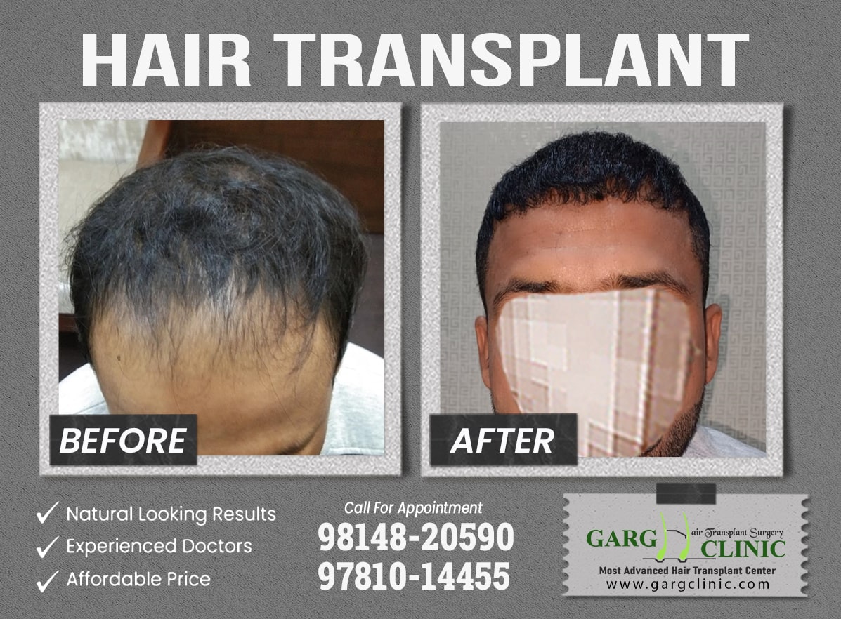 Garg Hair Transplant Clinic