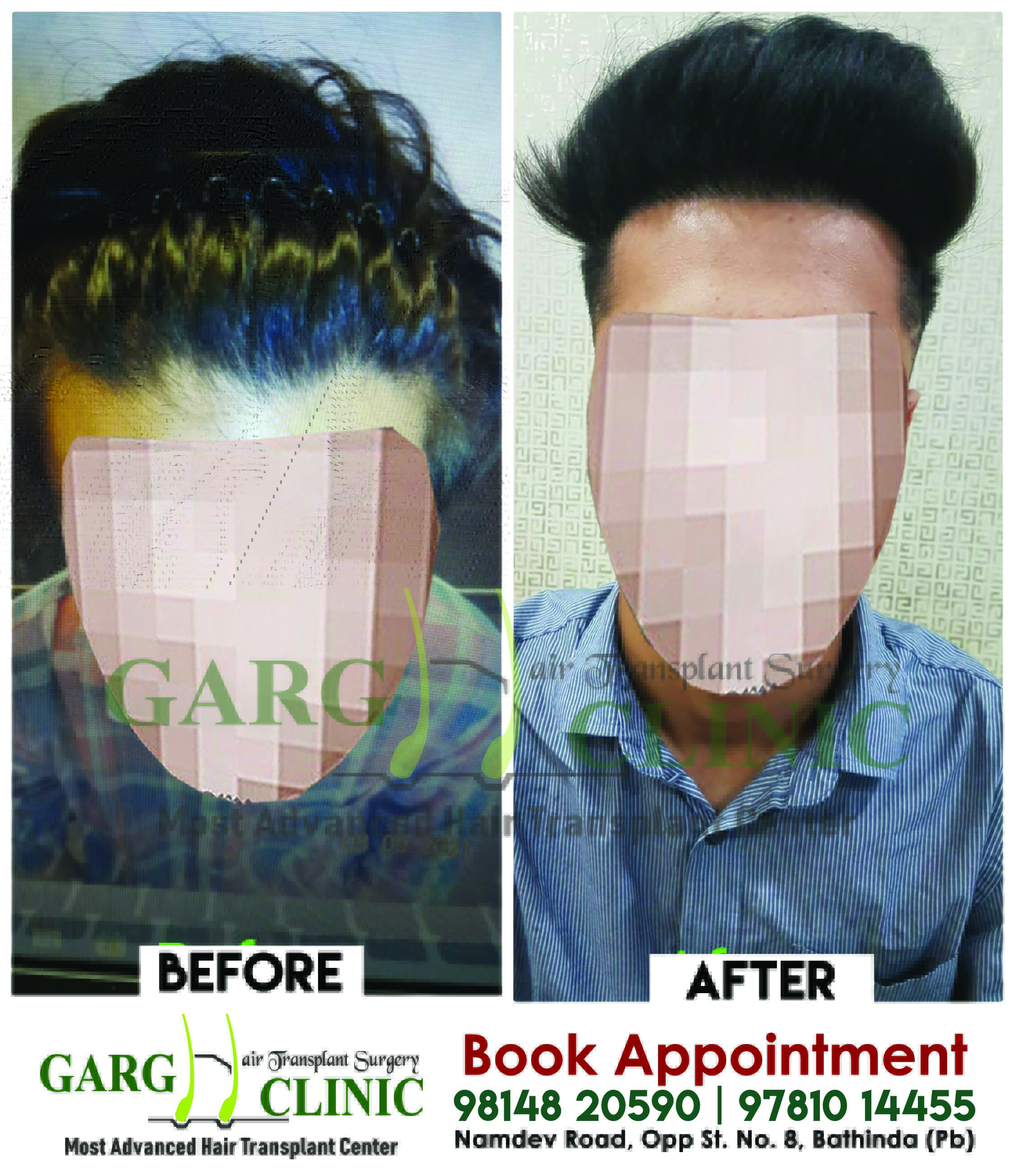 Garg Hair Transplant Clinic
