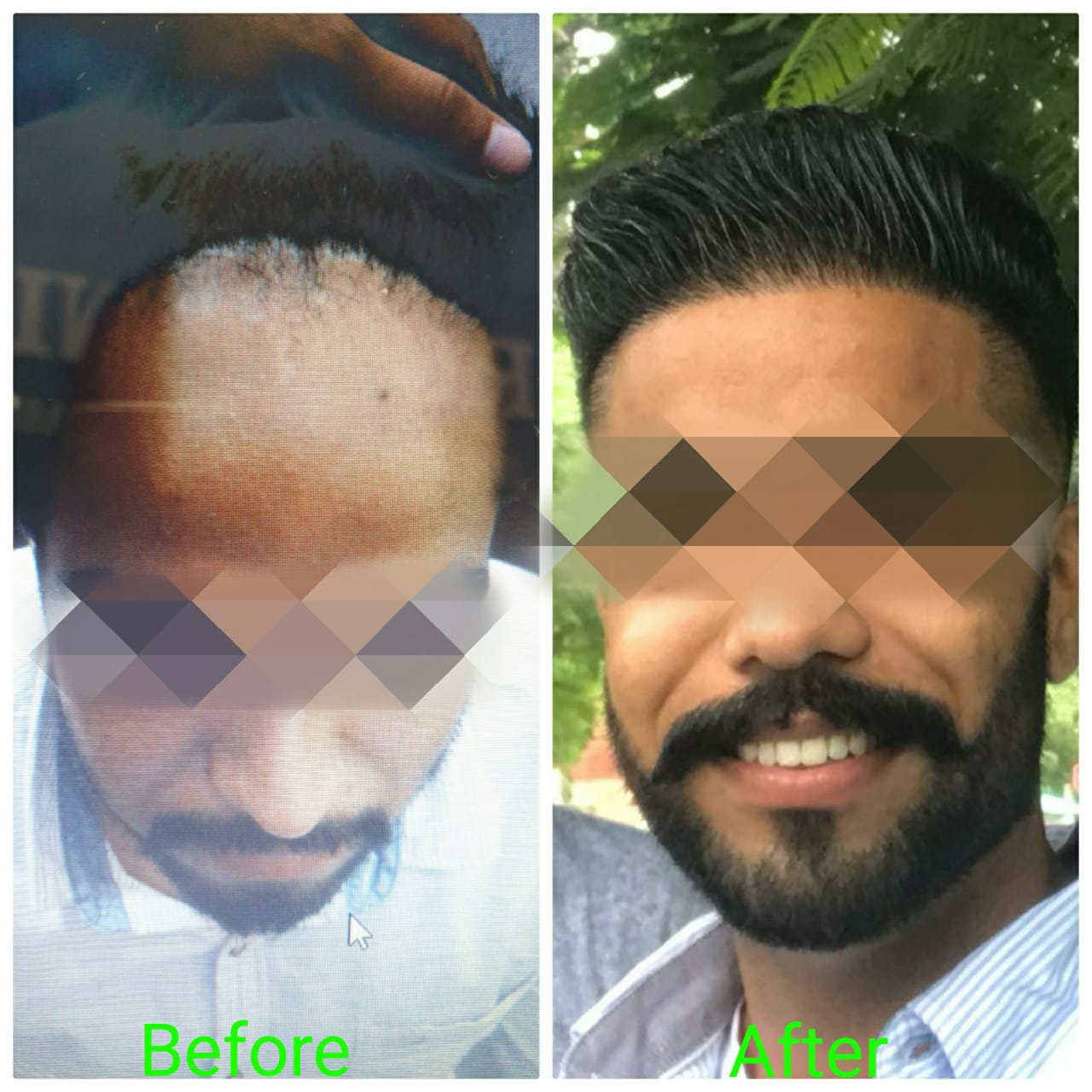 Garg Hair Transplant Clinic