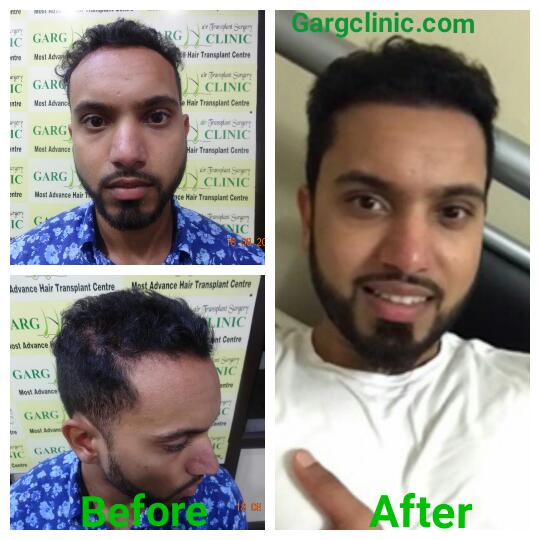 Garg Hair Transplant Clinic