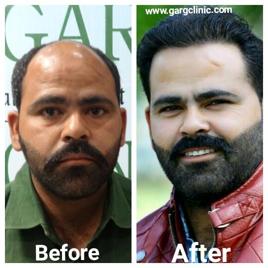 Garg Hair Transplant Clinic