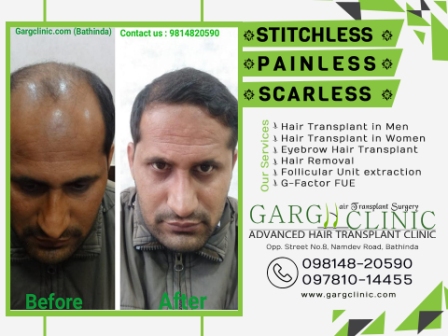 Garg Hair Transplant Clinic