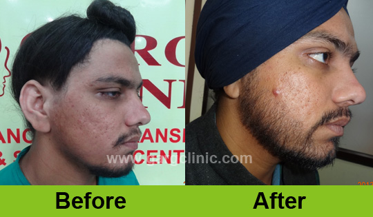 Garg Hair Transplant Clinic