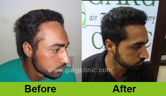 Garg Hair Transplant Clinic