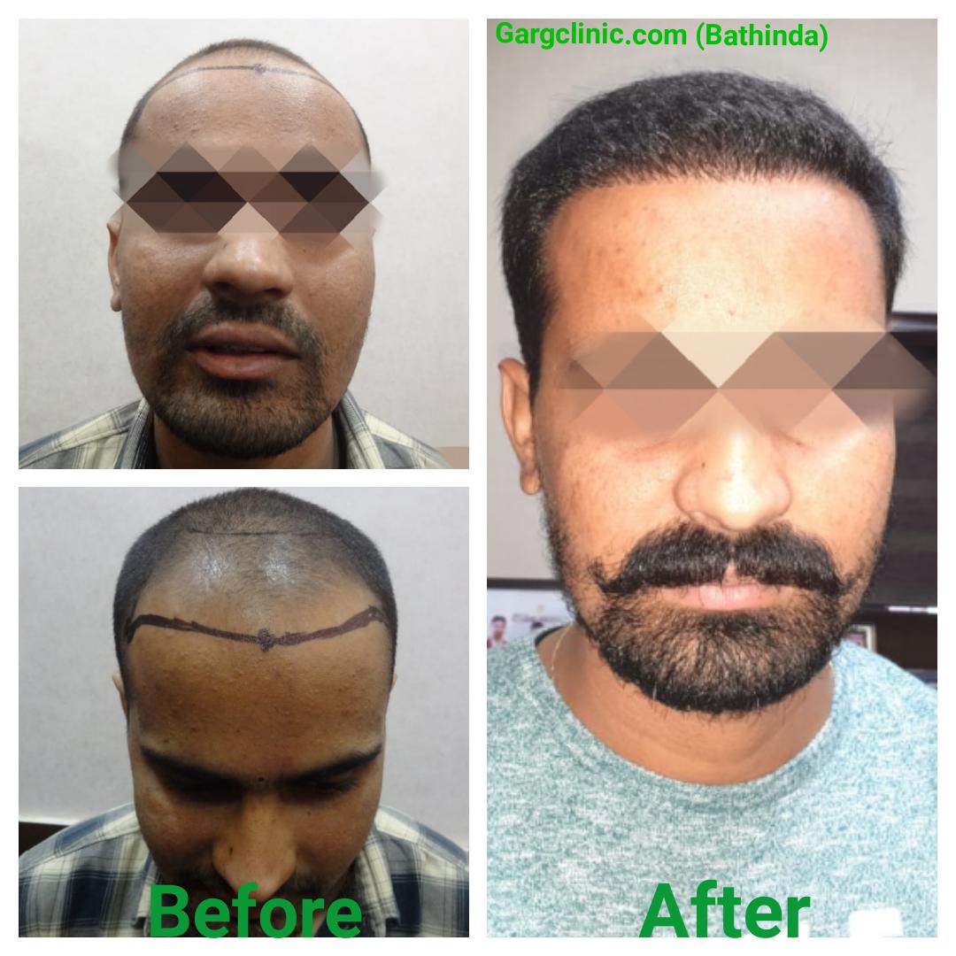 Garg Hair Transplant Clinic