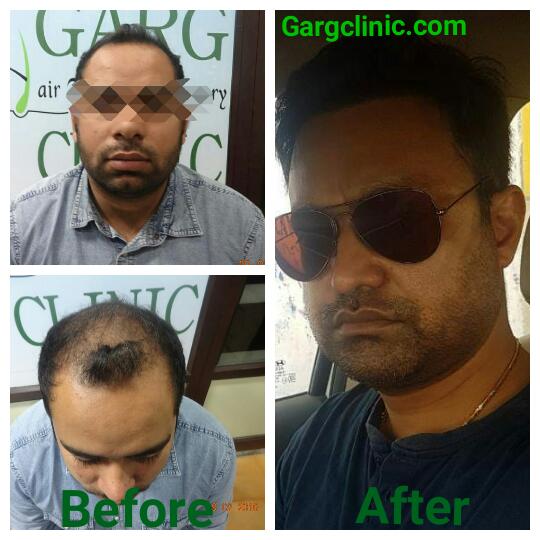 Garg Hair Transplant Clinic
