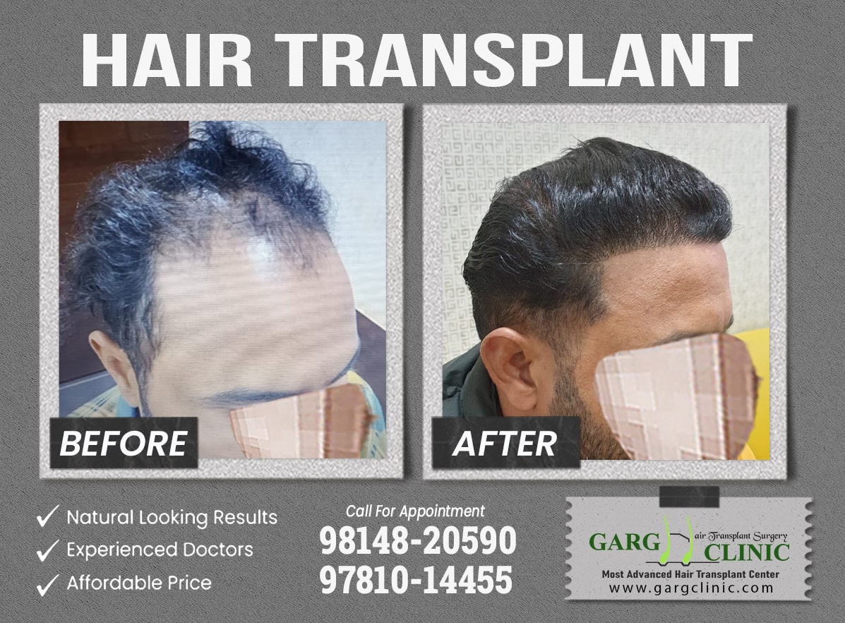 Garg Hair Transplant Clinic