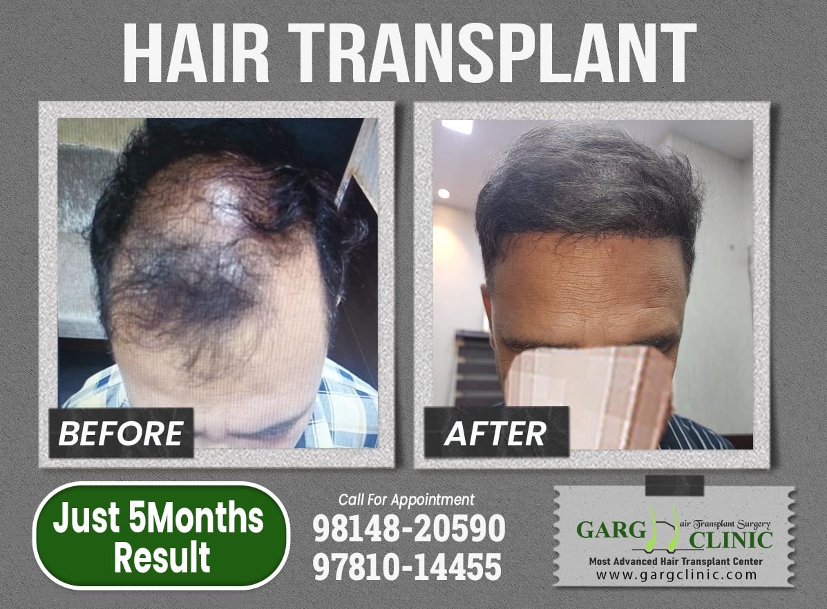 Garg Hair Transplant Clinic