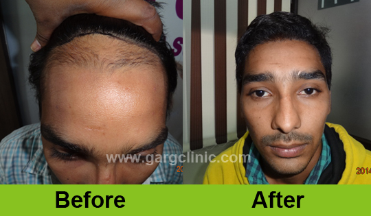 Garg Hair Transplant Clinic