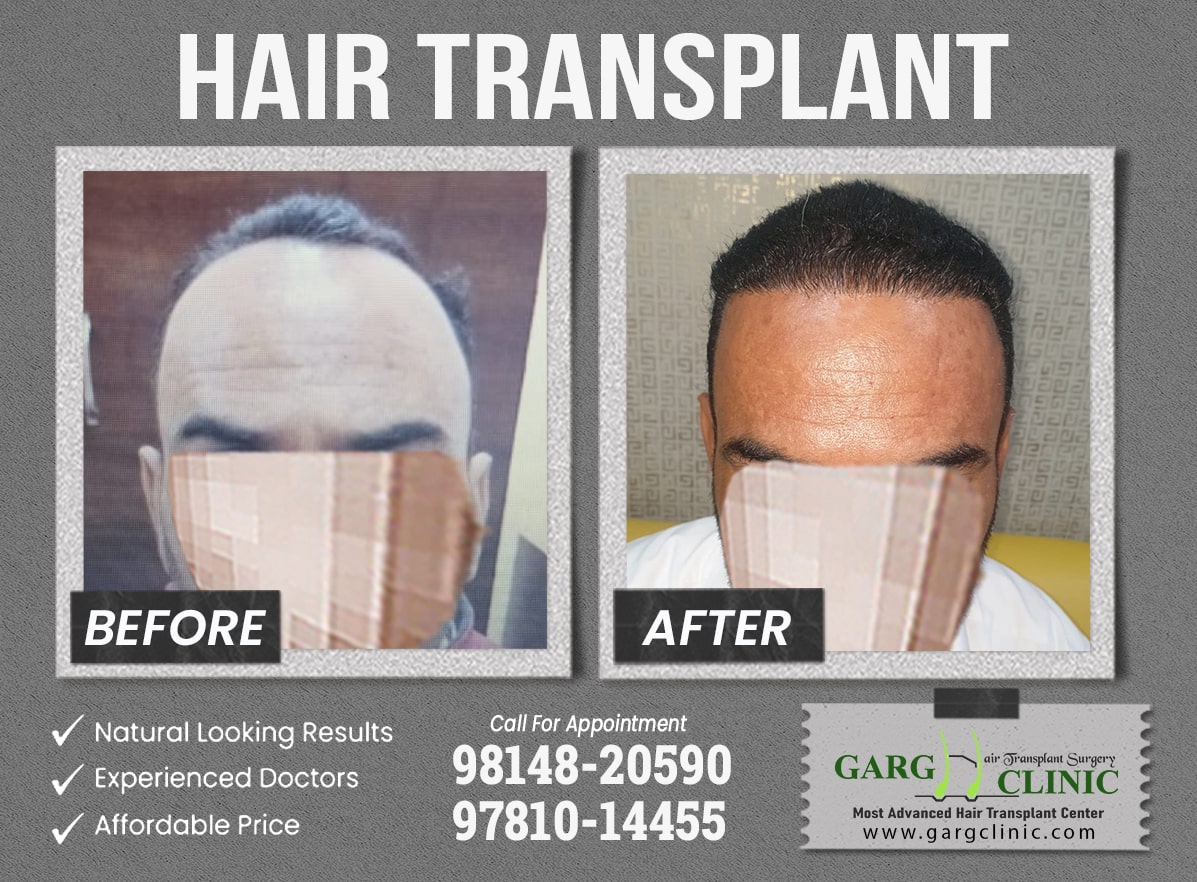 Garg Hair Transplant Clinic