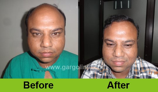 Garg Hair Transplant Clinic