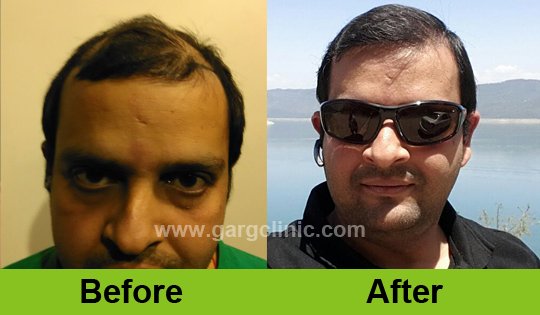 Garg Hair Transplant Clinic
