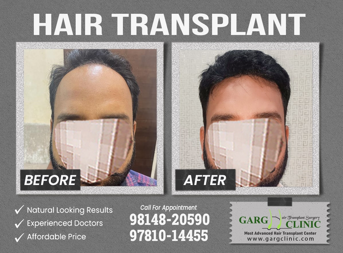 Garg Hair Transplant Clinic