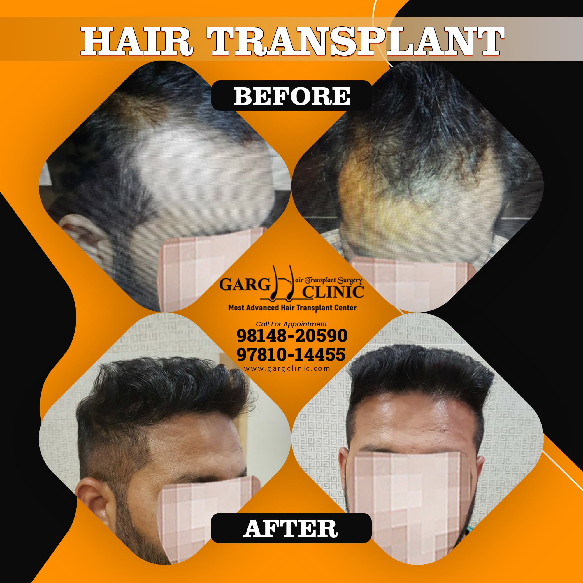 Garg Hair Transplant Clinic
