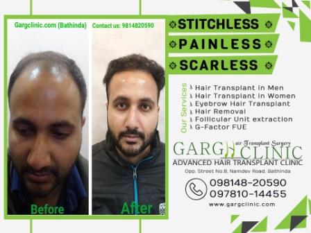 Garg Hair Transplant Clinic