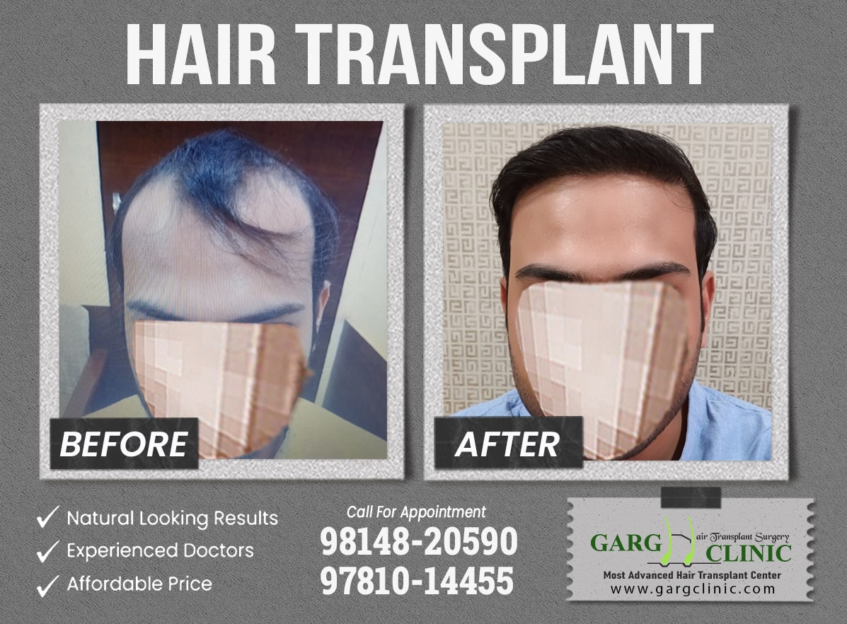 Garg Hair Transplant Clinic