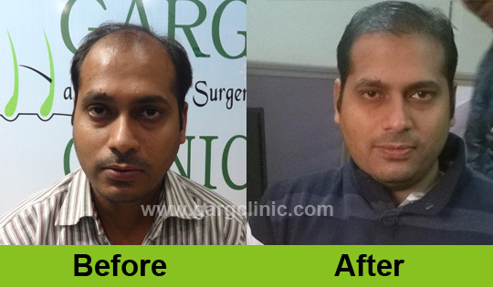 Garg Hair Transplant Clinic