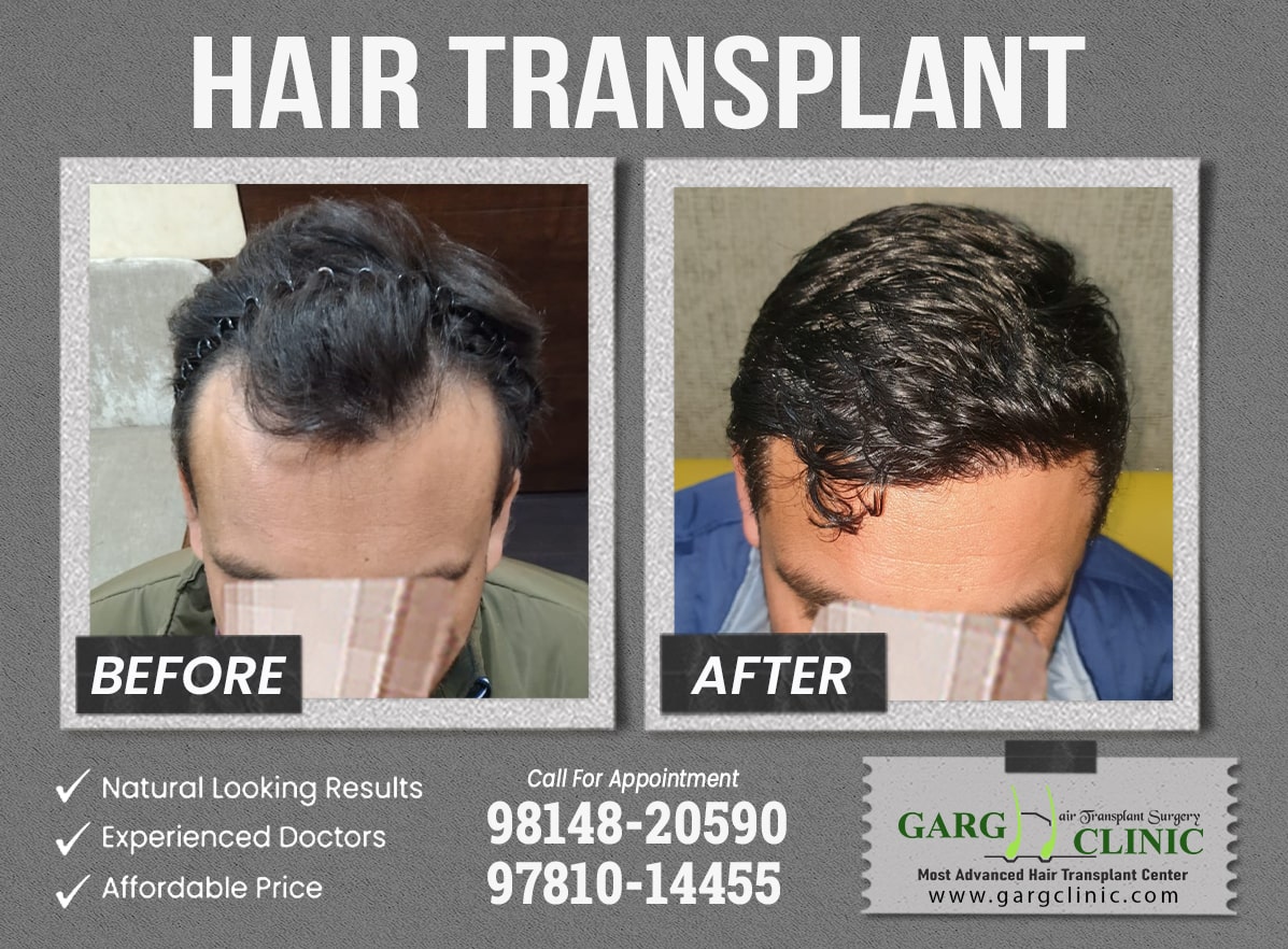 Garg Hair Transplant Clinic