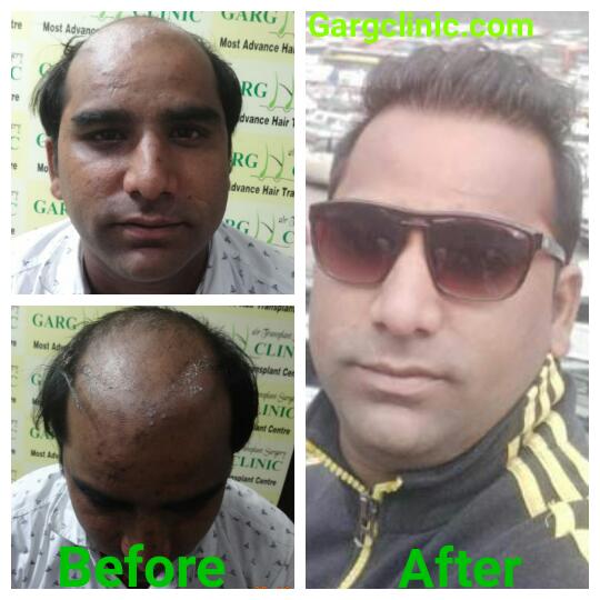 Garg Hair Transplant Clinic