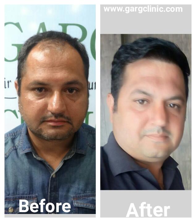 Garg Hair Transplant Clinic