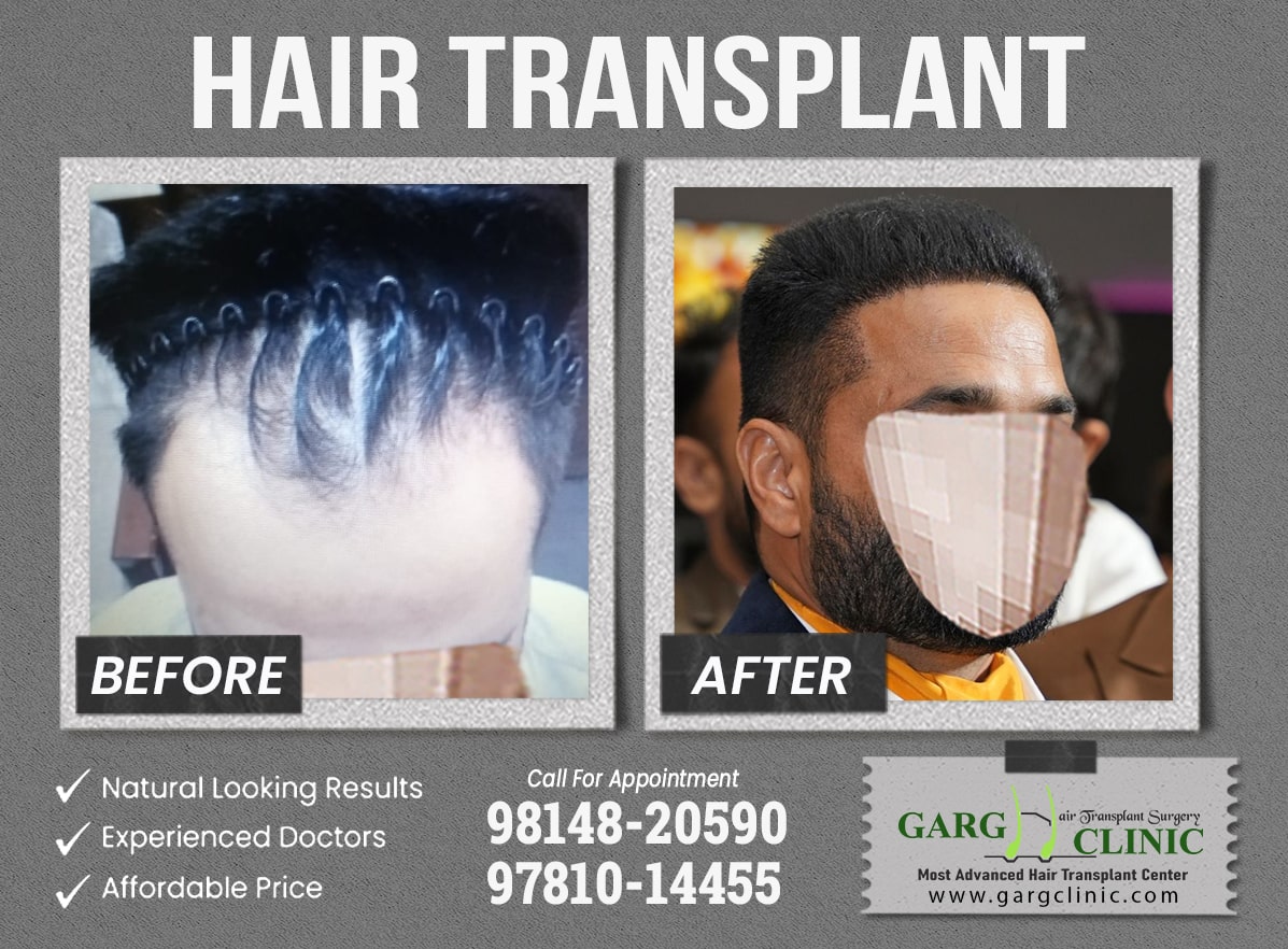Garg Hair Transplant Clinic