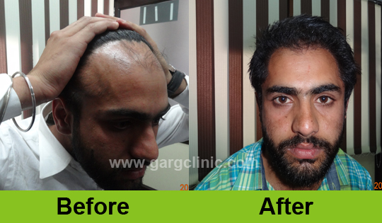 Garg Hair Transplant Clinic