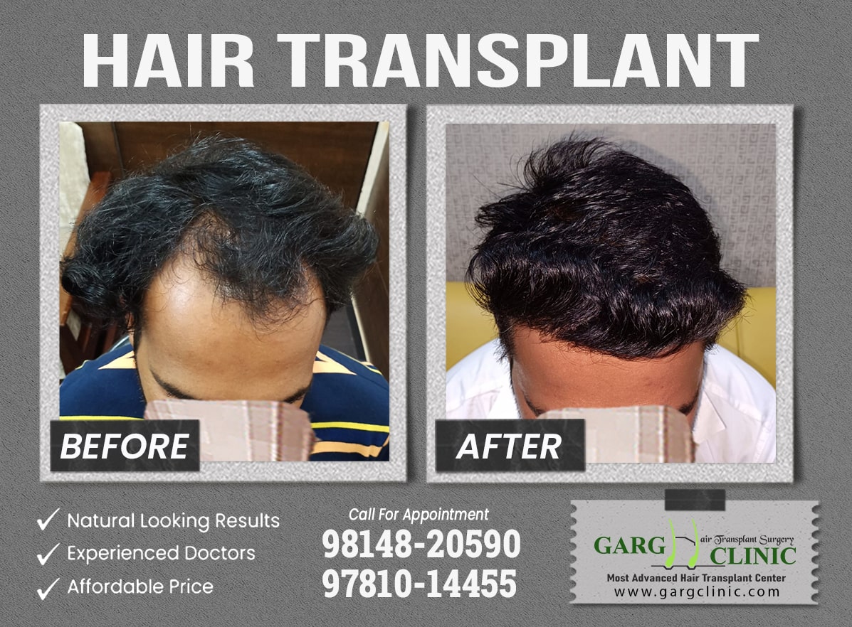 Garg Hair Transplant Clinic