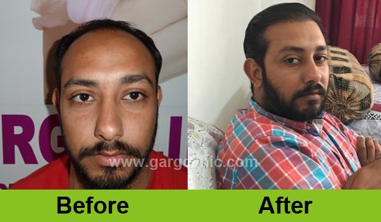 Garg Hair Transplant Clinic