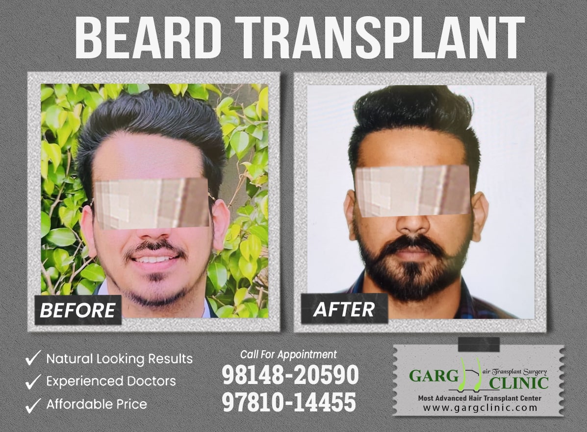 Garg Hair Transplant Clinic