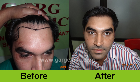 Garg Hair Transplant Clinic
